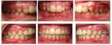 Correction of an overbite and overjet by Dr. Kendra Pratt and team ...