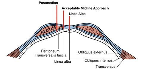 Identifying the Linea Alba & Avoiding Paramedian Incisions During ...