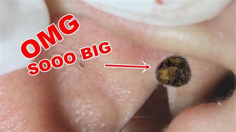 BIG EAR Blackheads Extraction - YouTube