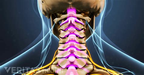 Cervical Foraminal Stenosis