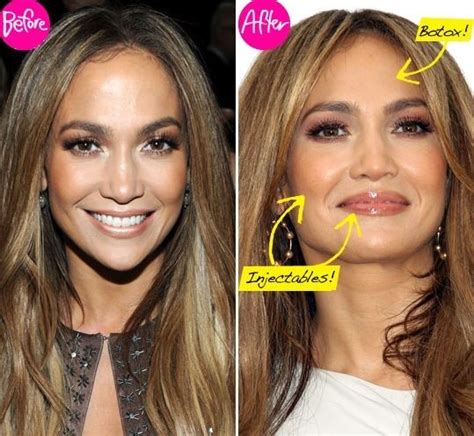 Jennifer Lopez before and after using botox 01 – Celebrity plastic ...