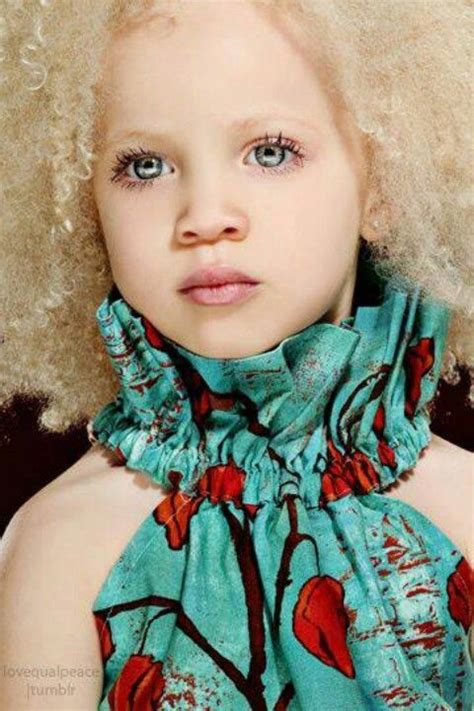 Albino people are often described as magical and persecuted because of ...