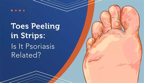 Toes Peeling in Strips: Is It Psoriasis Related? | MyPsoriasisTeam