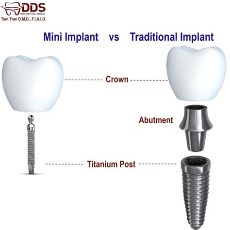 Mini Dental Implants - DocDentalSmile