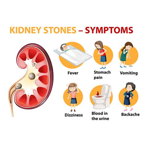 Kidney Stones - Chennai's Premier Hospital For Treatment of Kidney Stones