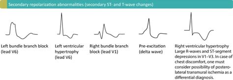 T-waves in ischemia: hyperacute, inverted (negative), Wellens sign & de ...