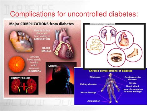 powerpoint presentation on diabetes mellitus