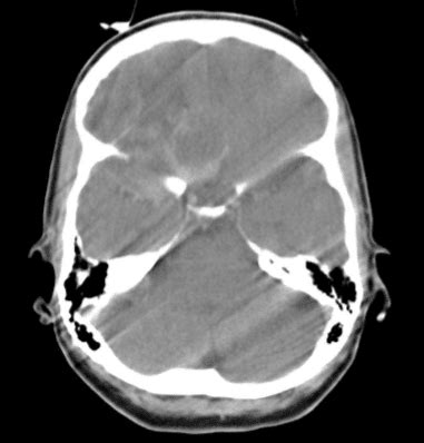 CT Artifacts | Oncology Medical Physics