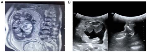 MRI of FIF. (A) MRI image of the fetus showed signals of a long bone in ...