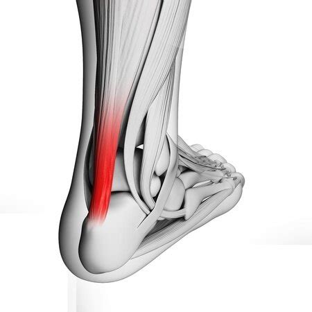 Foot Pain: Is it Your Achilles' Heel? — LIGHTHOUSE FOOT & ANKLE CENTER