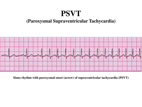 PPT - Prepared by : ANWAR ISSA RN-BSN-CCRT-ICU PowerPoint Presentation - ID:6390940