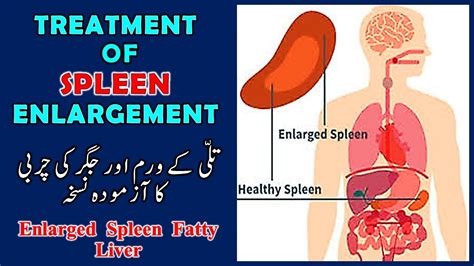 ENLARGED SPLEEN AND LIVER, How To Cure Swollen Spleen naturally - YouTube