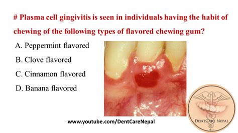 Dentosphere : World of Dentistry: Plasma cell gingivitis