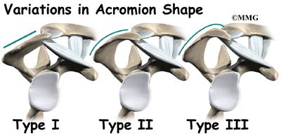 Impingement Syndrome - eOrthopod.com