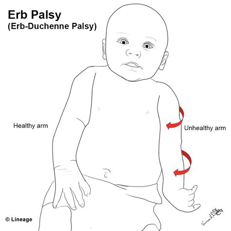 Erb-Duchenne Palsy - USMLE Strike