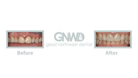 Cosmetic Dentistry Before/After