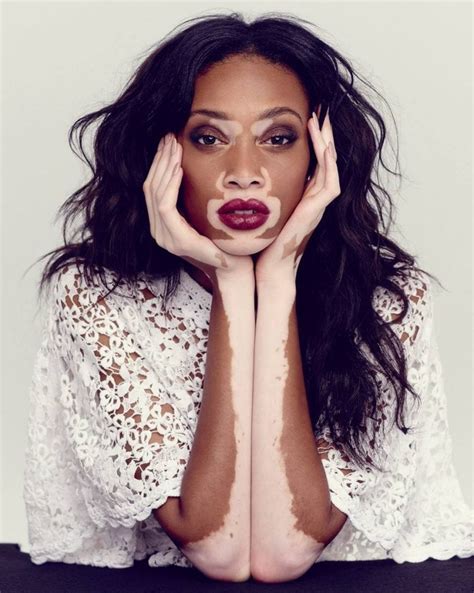 O que é vitiligo? Entenda a doença e como ela surge - Segredos do Mundo