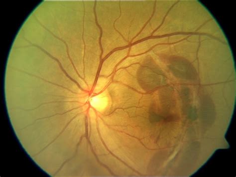 Choroidal Rupture - Retina Image Bank