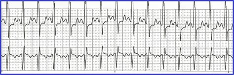 Atrial Fibrillation: Junctional Rhythm Vs Atrial Fibrillation