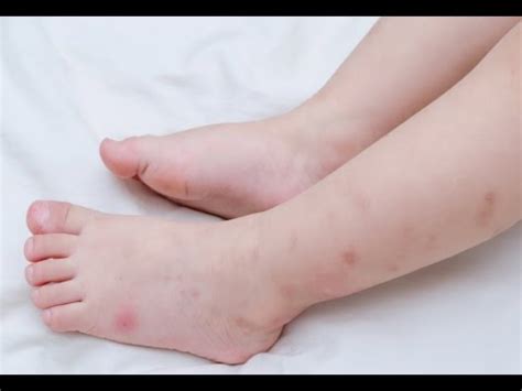 How to Treat Flea Bites on Babies - YouTube