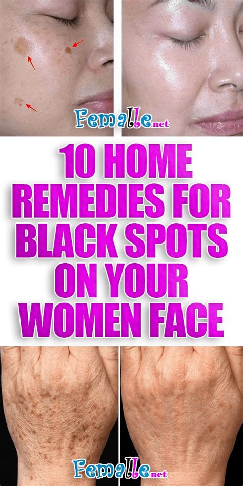 10 Home Remedies for Black Spots on Your Women Face | Woman face, Black ...