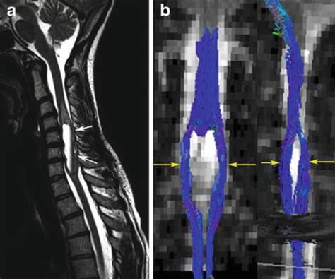 Ependymoma | Obgyn Key