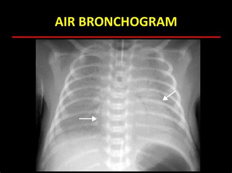 Air Bronchogram Chest X Ray