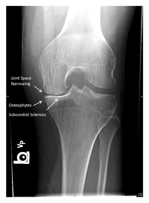 Examples of JSN, osteophytes, and subchondral sclerosis on a tunnel ...