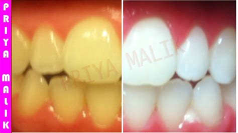 How To Make Your Yellow Teeth White Again - TeethWalls