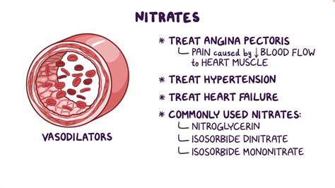 Nitrate Therapy - Osmosis Video Library