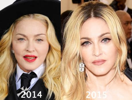 Madonna Plastic Surgery Before and After Photos