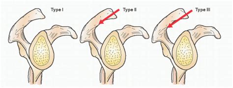 Tendinitis/Bursitis/Subacromial Impingement | Musculoskeletal Key