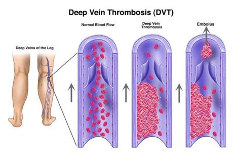 Avoiding blood clots in the legs during and after surgery