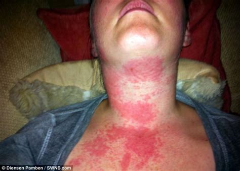 iPhone cover causes allergic reaction covering woman's face and neck in ...