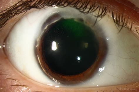 Marginal Corneal Degeneration