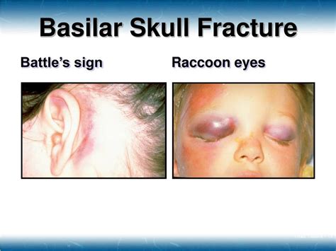 PPT - Head Trauma PowerPoint Presentation, free download - ID:3466923