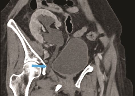 Ureteral Obturator Hernia | Applied Radiology