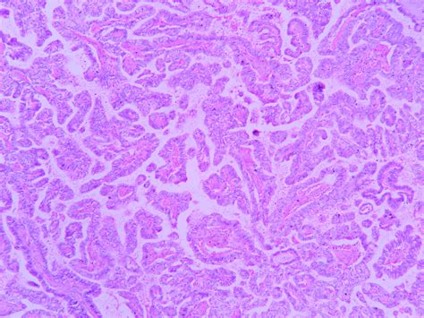 Papillary carcinoma – Thyroid – Histopathology.guru