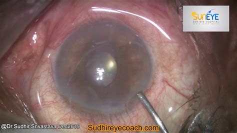 Normal Corneal Edema After Cataract Surgery