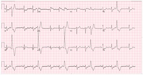 Cureus | Bidirectional Ventricular Tachycardia in Acute Multivessel ...