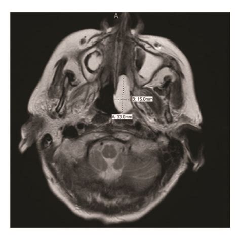 MRI brain: three abnormal bone marrow lesions (left clivus, right ...