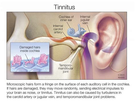 Eustachian Tube Dysfunction (ETD) - Symptoms & Treatment