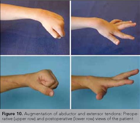 What Is Upper Limb Spasticity Symptoms Causes Treatment