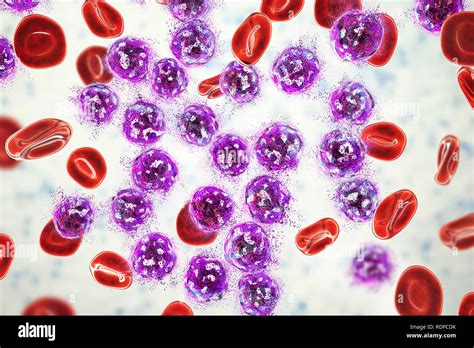 Acute lymphoblastic leukaemia treatment concept. Computer illustration showing destruction of ...