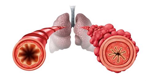 Vaping and Popcorn Lung - Medicine.com