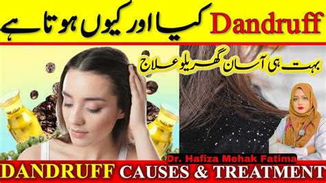 Dandruff ka asaan ilaj | Dandruff causes & Treatment | What is Dandruff - YouTube