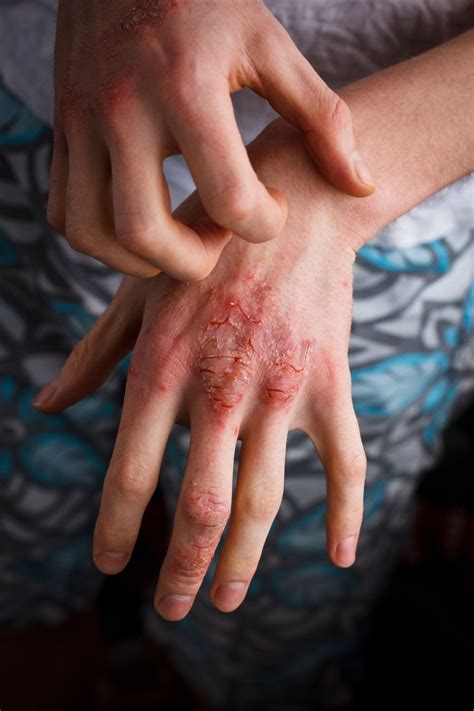 Hand Eczema | About and Treatments | Eczema.org