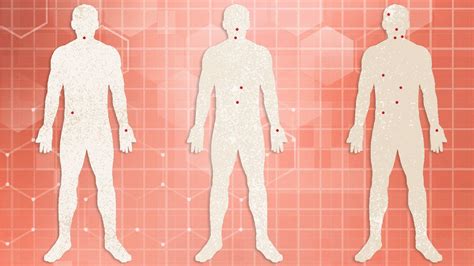 Acute Hiv Symptoms