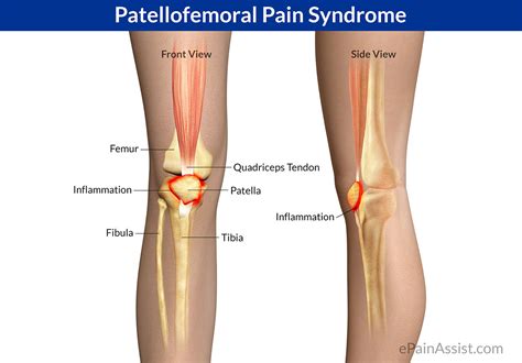 ITB Syndrome vs Patellofemoral Pain - Capital Area PT & Wellness