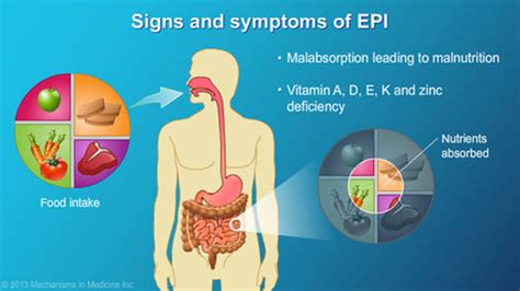 Slide Show - Exocrine Pancreatic Insufficiency (EPI)